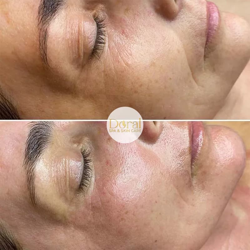 Facial treatment results at Doral Med Spa